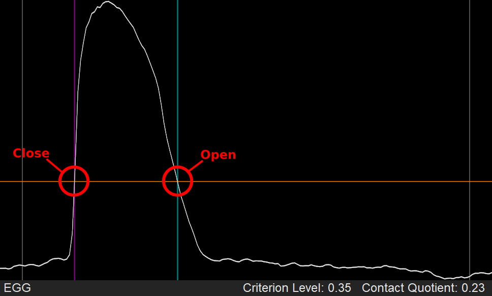 Using Criterion Level at 35% for estimating glottal contact period