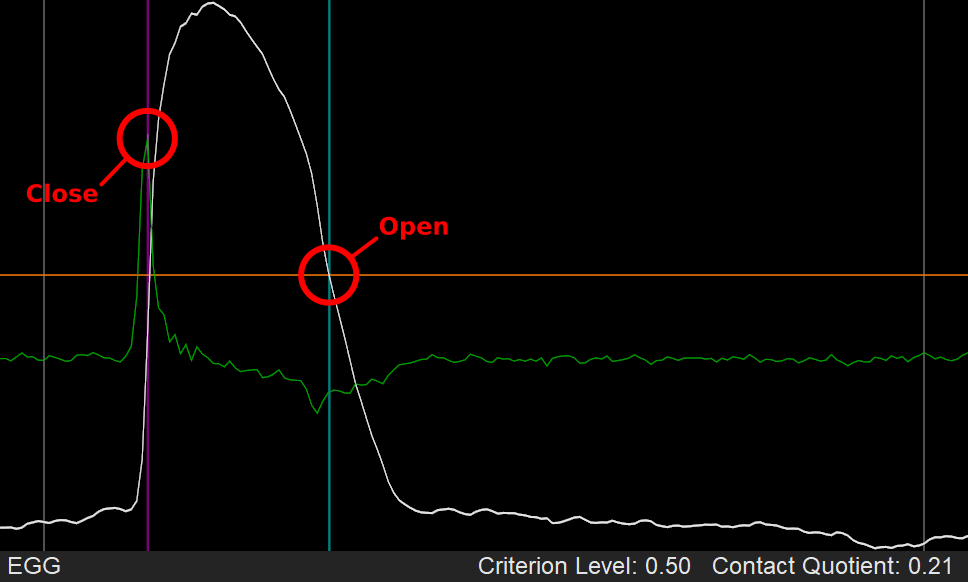 Using dEGG max for glottal closure, and Criterion Level at 50% for estimating glottal opening